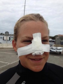 Caroline Vandame bricht sich bei einer Kenterung das Nasenbein segelt die Serie im 49er FX aber dennoch zuende. © Meyer Nasenbein gebrochen im 49er FX